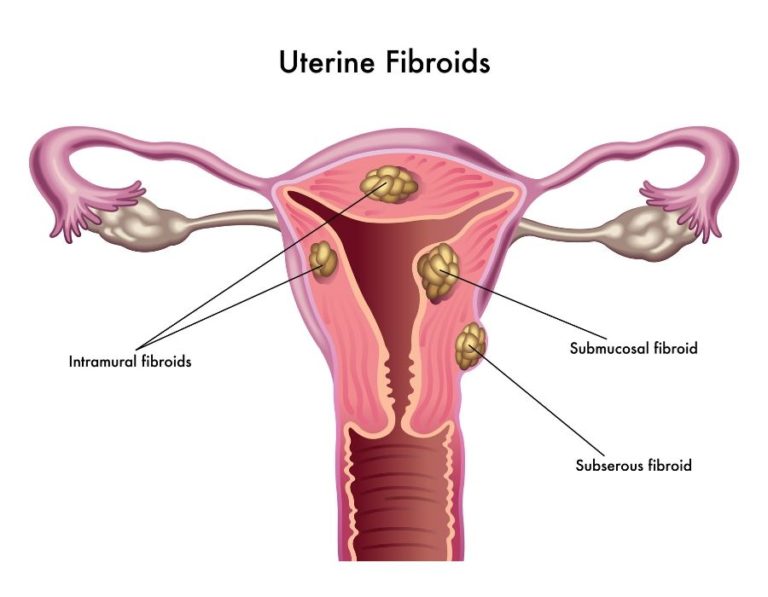 Ovarian Cysts And Fibroids What S The Difference Usa Fibroid Centers