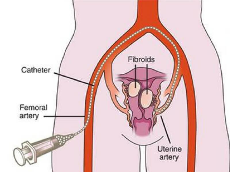 A Visual Guide To Uterine Fibroid Embolization (Ufe) 1 Example of UFE