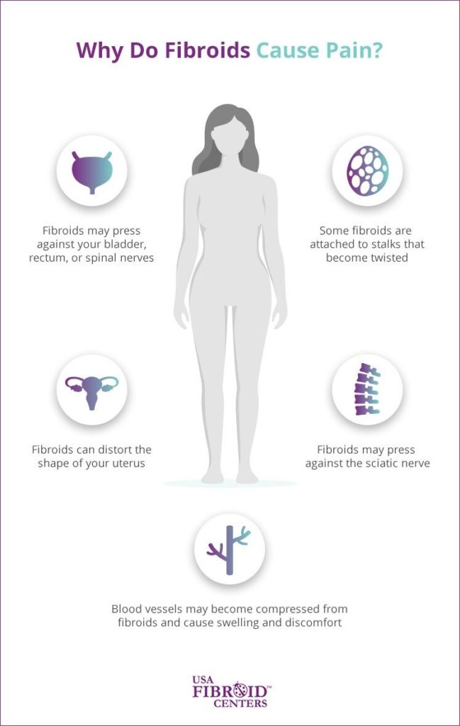 how-fibroid-pain-affects-your-lower-back-and-legs