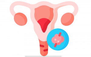Graphic of fibroids in uterus