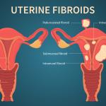 A Beginner’s Guide to Uterine Fibroids