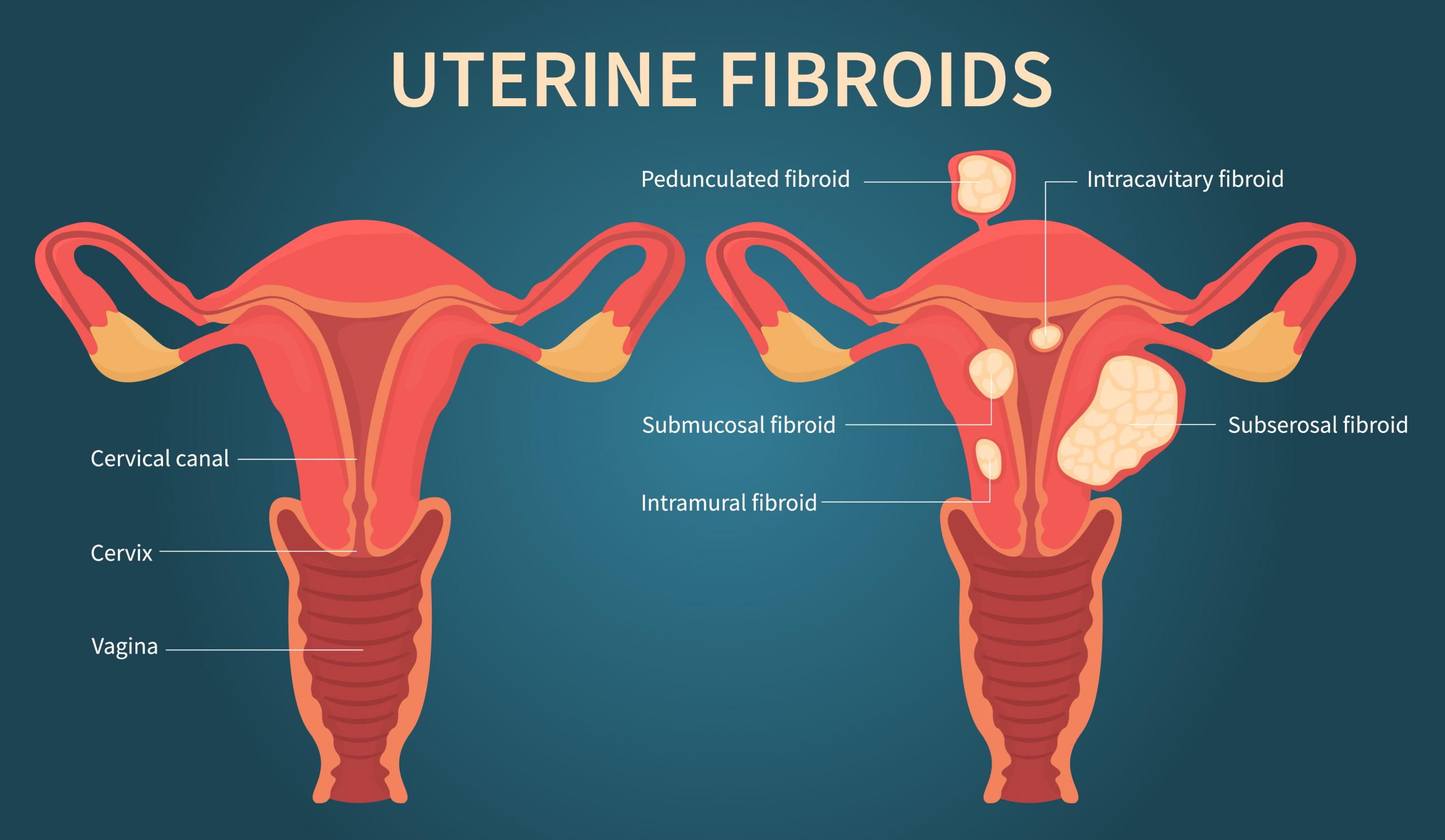 wandering fibroid definition