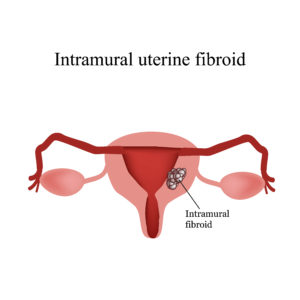 Diagram of an intramural uterine fibroid.