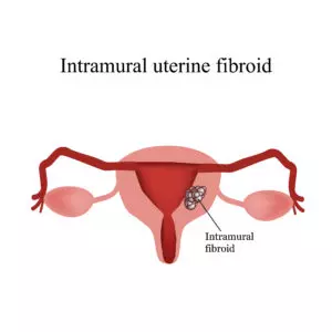 Types of Intramural Fibroids