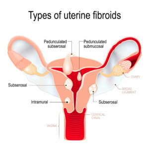 A labeled medical diagram or types of Uterine Fibroids. 