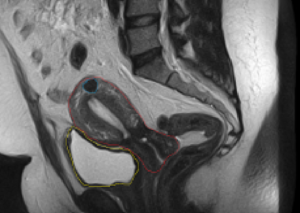 Ultrasound (or sonogram) of a uterus