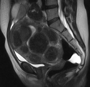 Ultrasound (or sonogram) of a uterine fibroid