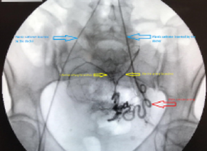 Catheter is threaded within uterine artery: highlighted