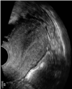 An ultrasound of a woman's uterus