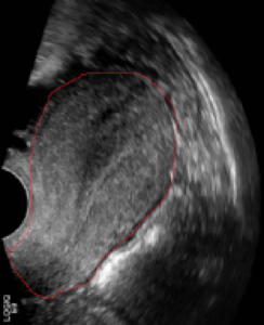 Ultrasound (or sonogram) 
