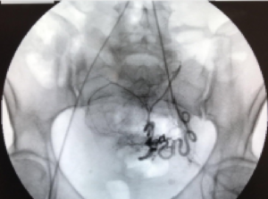 Catheter is threaded within the squiggly uterine artery 