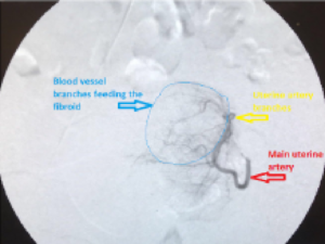 Plastic catheter going into uterine artery, shrinking the uterine fibroid: highlighted.