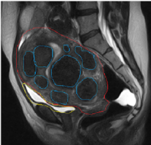 Highlighted ultrasound of a uterine fibroid