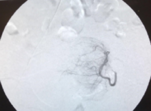 Plastic catheter going into uterine artery, shrinking down the uterine fibroid. 