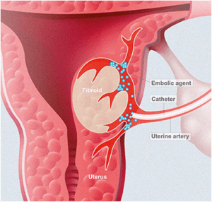 Uterine Fibroid Embolization Example