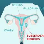 What Are Subserosal Fibroids?