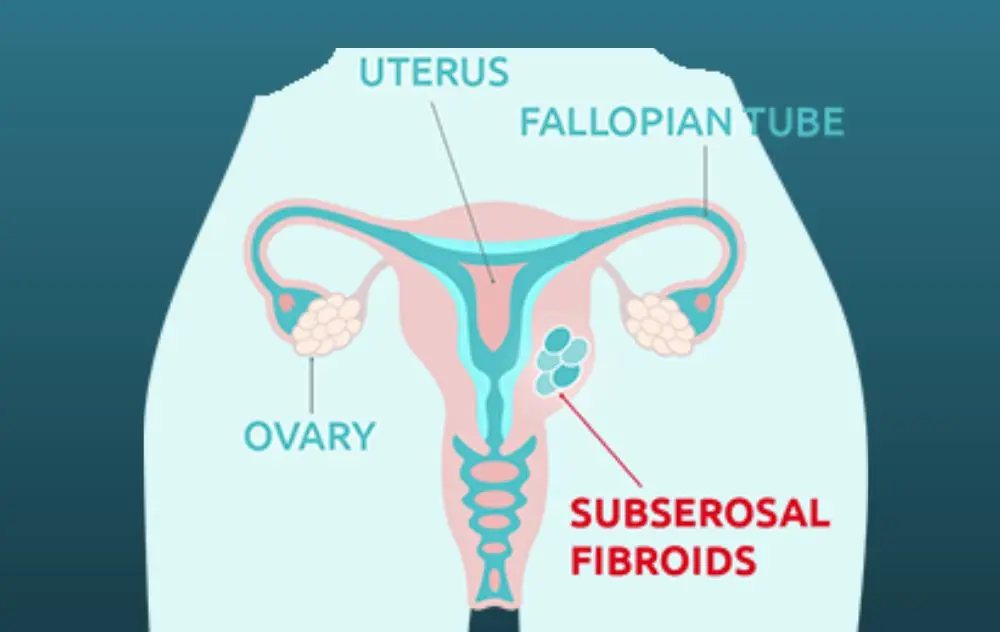 What Are Subserosal Fibroids? 2 What Are Subserosal Fibroids?