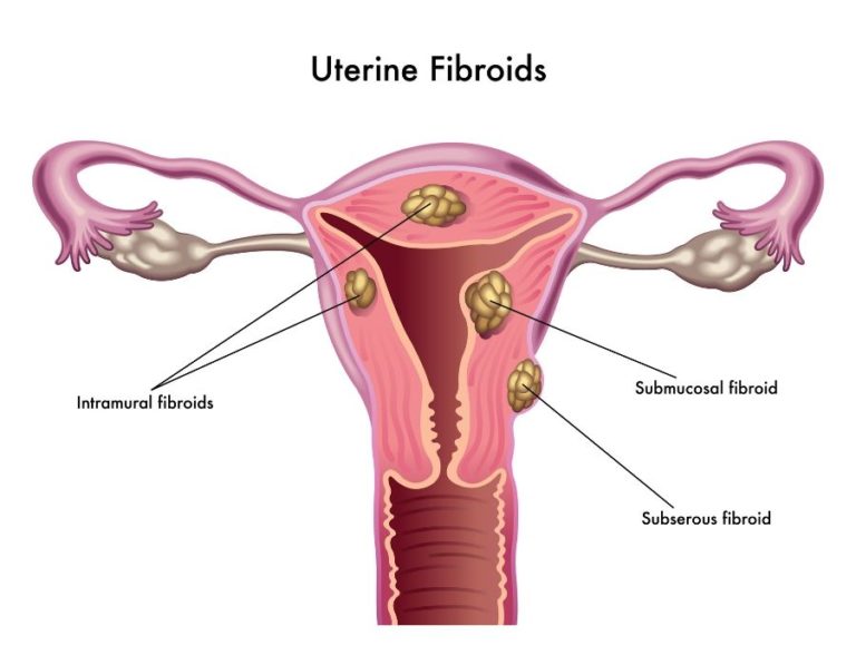 Ovarian Cysts and Fibroids What's the Difference? USA Fibroid Centers