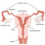Uterine fibroids and uterine polyps. What is the difference between a polyp and a fibroid?