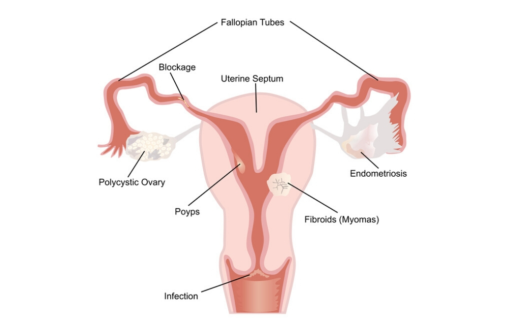 Uterine fibroids and uterine polyps. What is the difference between a polyp and a fibroid?