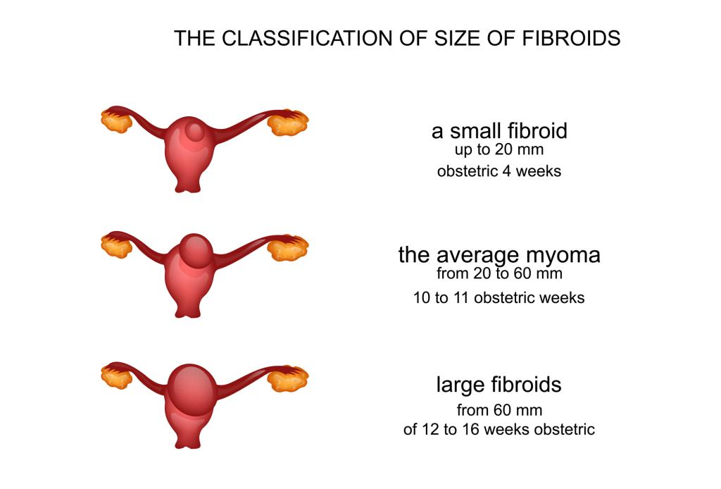 visual guide to fibroid sizes