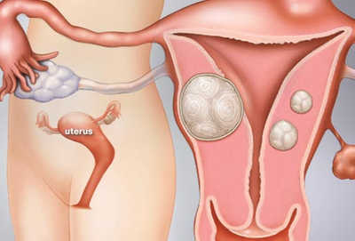 Different Size Uterine Fibroids