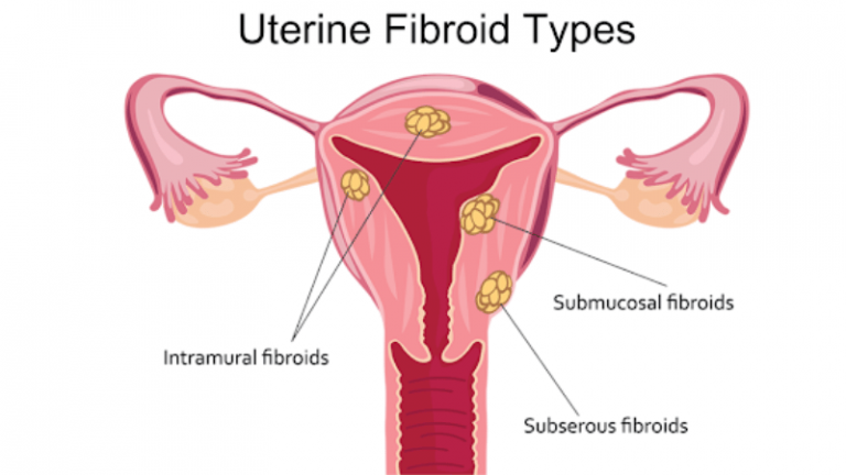 Telegram Download Can Fibroids Cause Bleeding During Sex