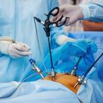 Myomectomy procedure