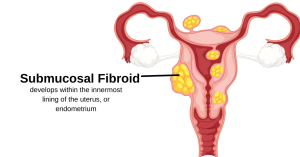 Uterine fibroids