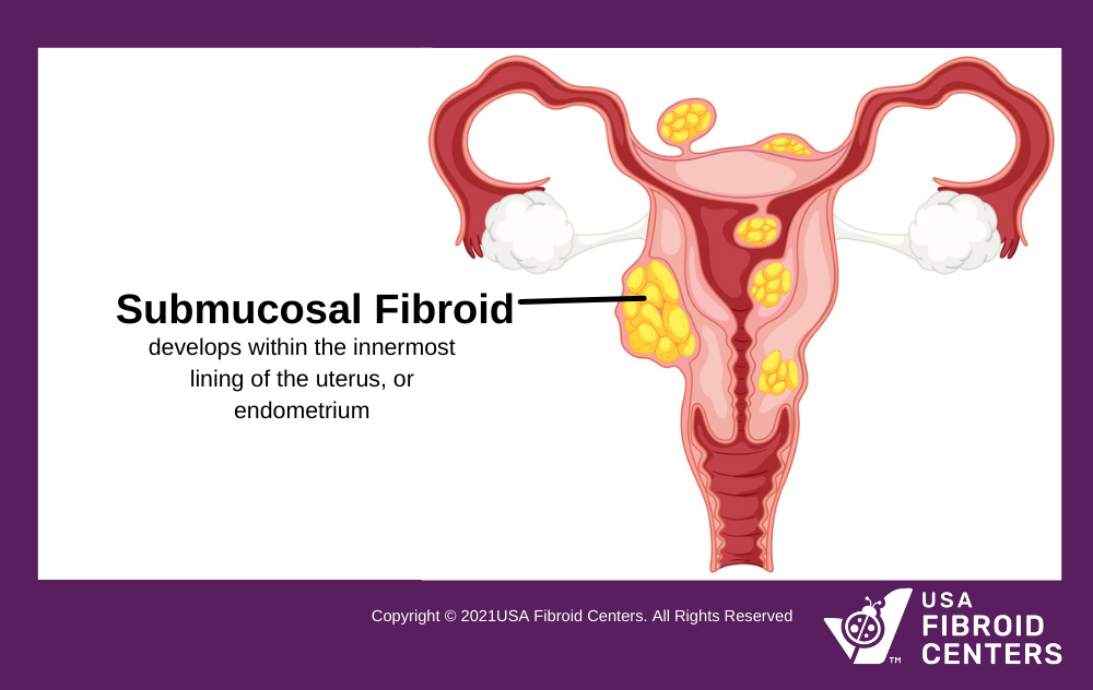 Uterine fibroids