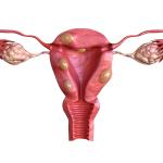 Picture of Uterine Fibroids