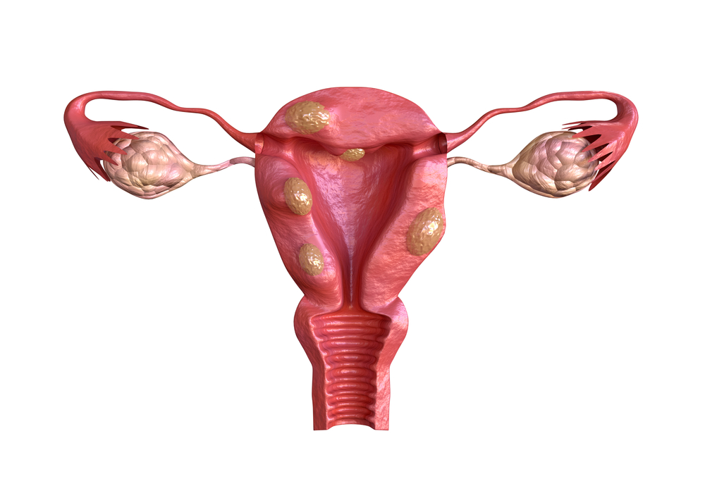 Picture of Uterine Fibroids