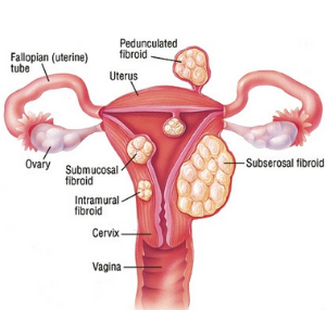 Uterus with fibroids
