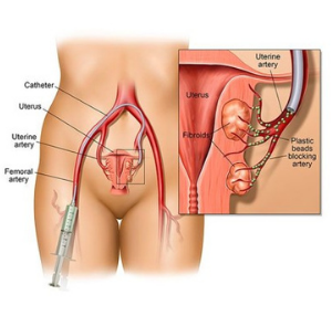 Image of Uterine Fibroid Embolization