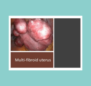 Multi-fibroid uterus