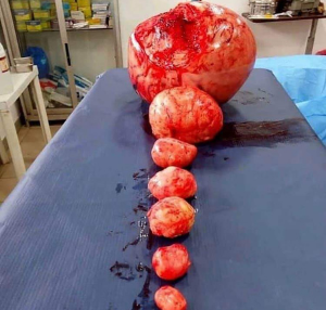 Image of different size fibroids