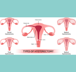 types of hysterectomy