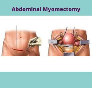 abdominal myomectomy