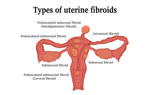 Pedunculated Fibroid infographic