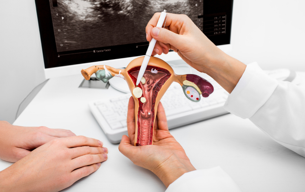 doctor showing where pedunculated fibroids are located