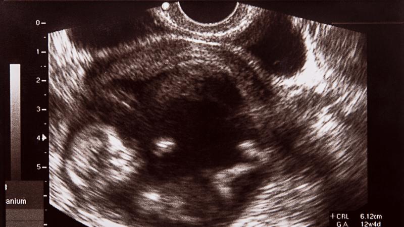 Fetal sonogram showing a baby in the womb.
