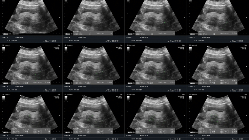 Ultrasound showing stages of fibroid growth in the uterus.