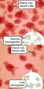 Symptoms of anemia vary 