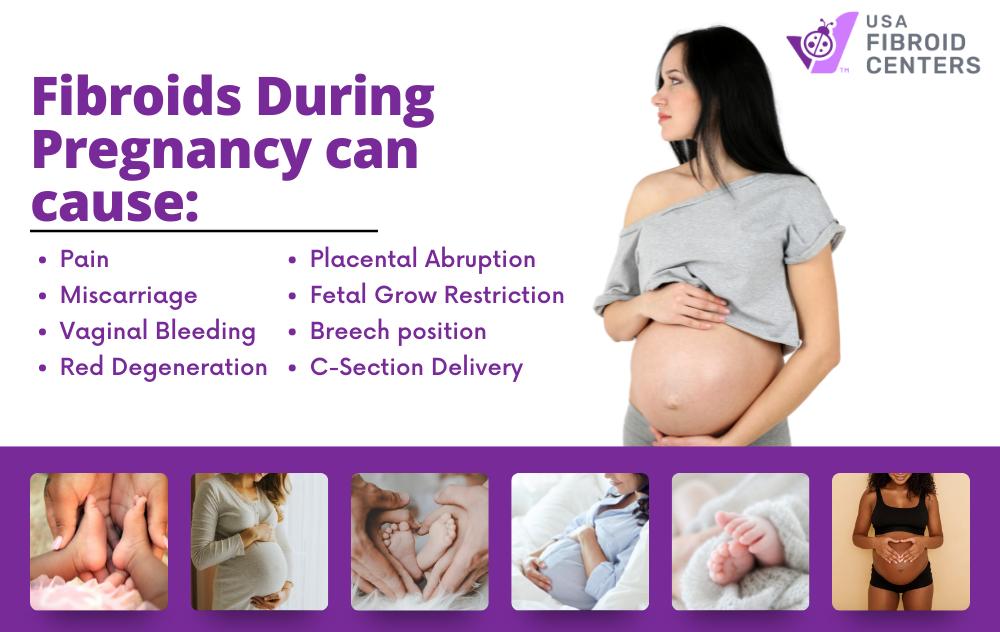 fibroids and pregnancy