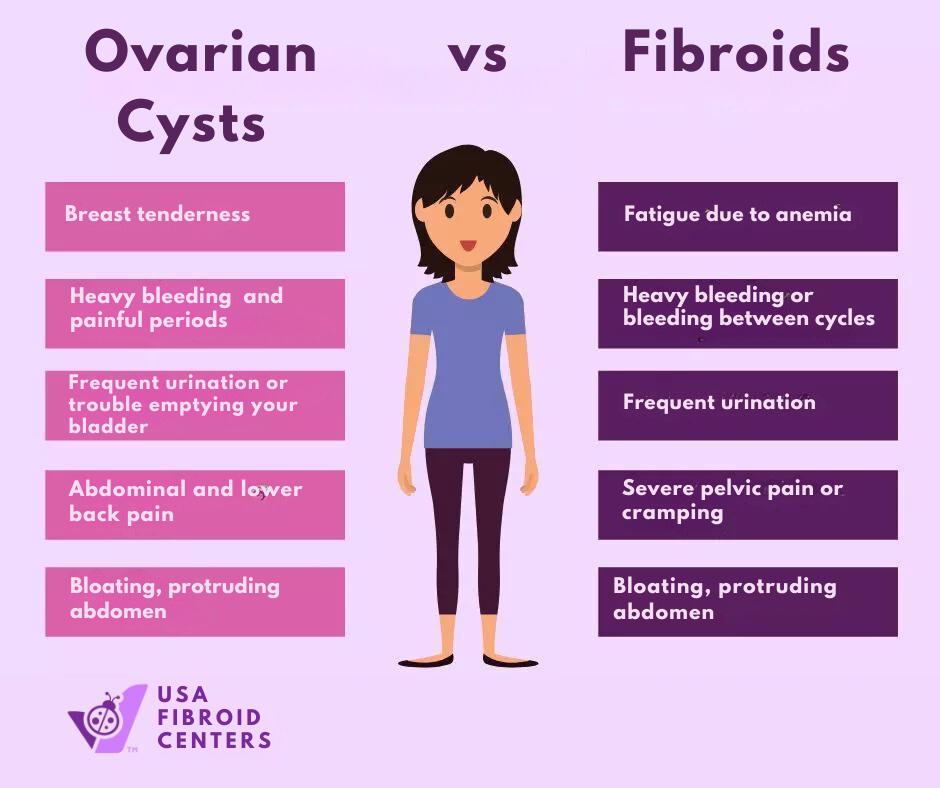 Ovarian Cysts vs Fibroids