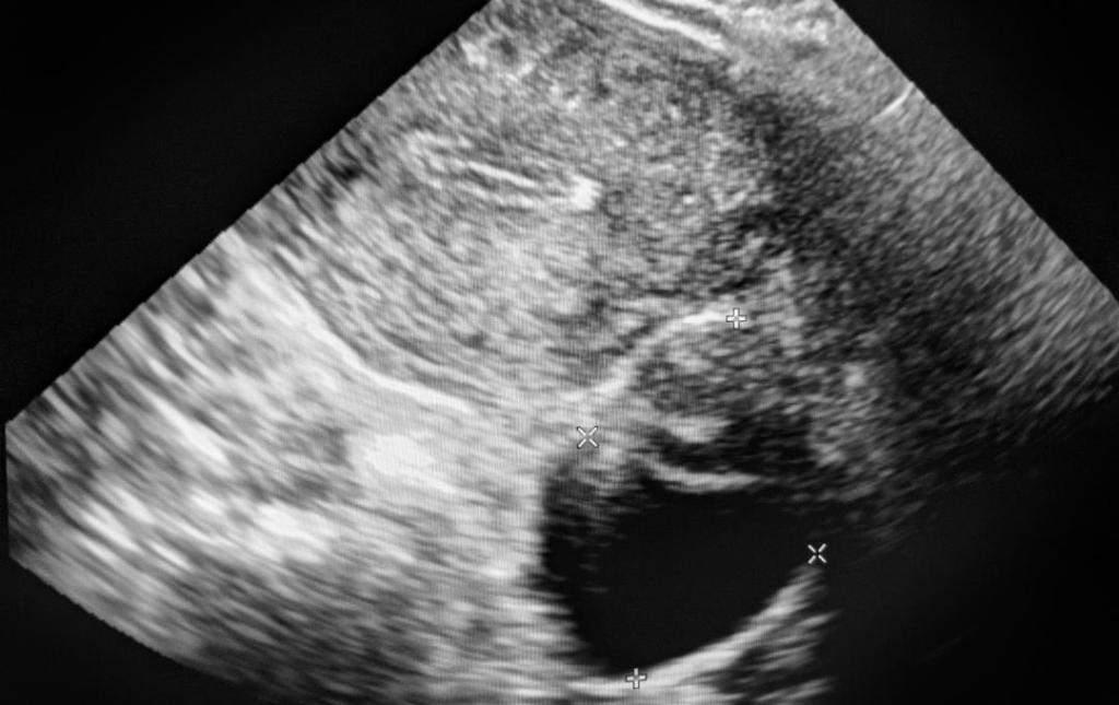  Ovarian cyst as seen through an ultrasound 