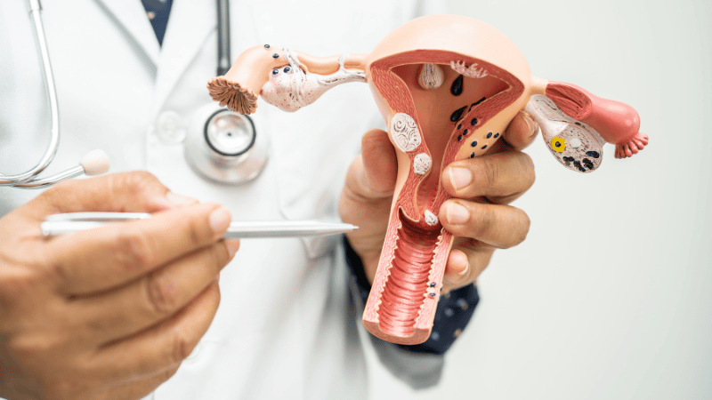 Why Fibroids Rarely Disappear Without Help