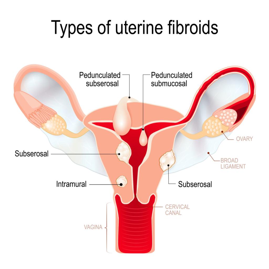 Typs of Uterine Fibroids