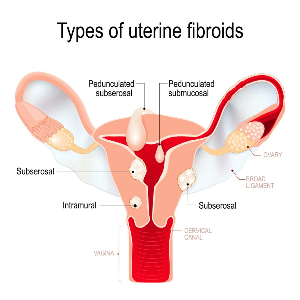 Uterine Fibroids after Menopause