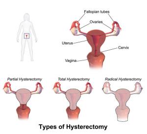 Hysterectomy Types